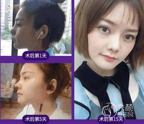 青岛伊美尔杨文国隆鼻怎么样,附杨文国隆鼻真实案例对比