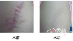 天津哪家医院去疤痕果好?