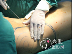 <b>抽脂手术风险大吗,都有哪些后遗症?可恢复吗?</b>