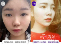 <b>余文婕双眼皮怎么样,有没有失败案例?</b>