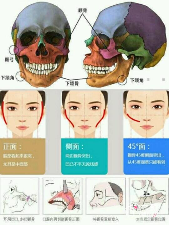 （郑州）河南中医药大学赵绛波颧骨内推怎么样,有没有失败案例