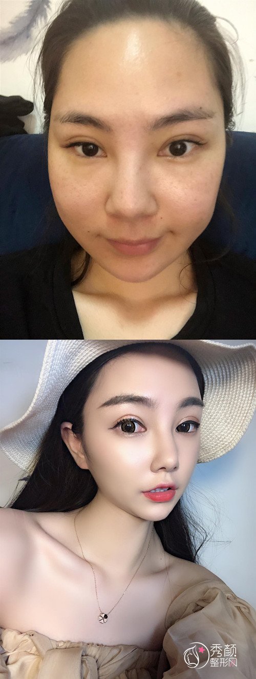 南京省中医院刘育凤磨骨怎么样,有没有失败案例?