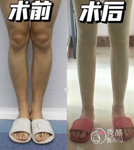 直腿术能改善O型腿吗？直腿术一般多少钱?