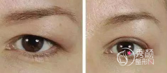 <b>上海九院提眉手术谁做得好,上海九院提眉手术果怎么样</b>