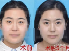 <b>沈阳腾采整形孟强医生双眼皮修复怎么样,贵不贵？</b>