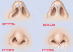 <b>鼻翼缺损怎么修复,鼻再造术可以吗?</b>