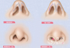 <b>上海九院韦敏教授鼻翼缺损修复技术怎么样</b>