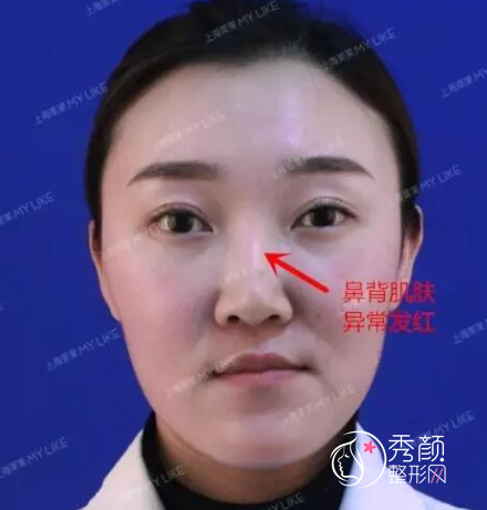 上海鼻子修复哪个医生好,李战强假体隆鼻修复案例参考。