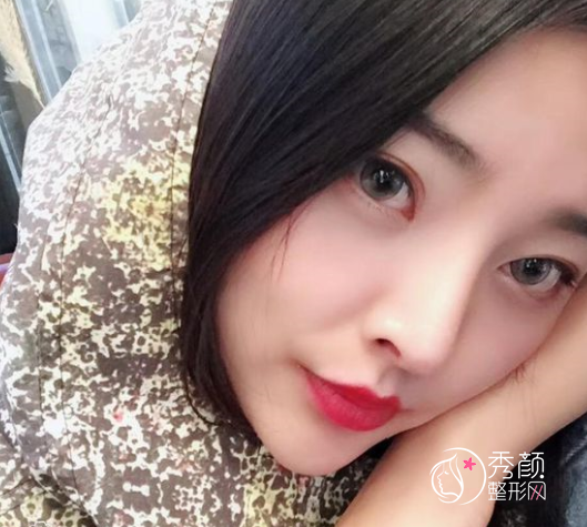 鼻部手术＋脂肪填充全脸一共花了52000多,大家都来看看我做得好看吗？