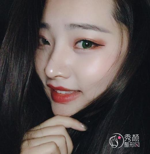 鼻部手术＋脂肪填充全脸一共花了52000多,大家都来看看我做得好看吗？