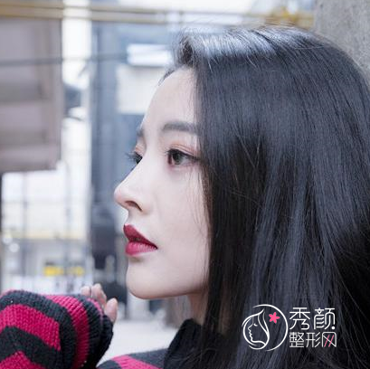 鼻部手术＋脂肪填充全脸一共花了52000多,大家都来看看我做得好看吗？