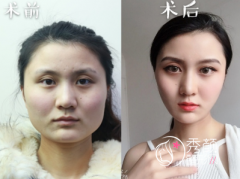 <b>磨骨风险大吗?有什么后遗症?怎么避免?</b>