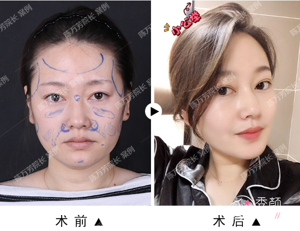 北京联合丽格陈万芳脂肪填充怎么样,有没有失败案例？