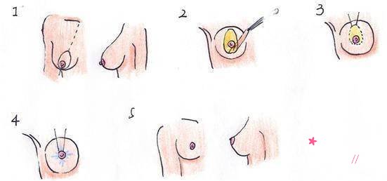 人工韧带乳房提升术多少钱?