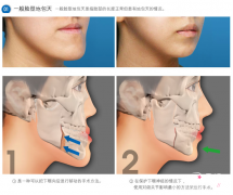 <b>有谁做过地包天手术，地包天手术过程图解</b>