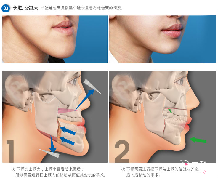 有谁做过地包天手术，地包天手术过程图解