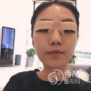 广州军美王高峰医生割双眼皮怎么样,有没有失败案例?