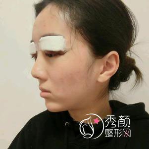 桂林美莱毛建文医生割双眼皮怎么样,有没有失败案例?
