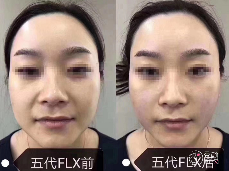 热玛吉的果到底怎么样?