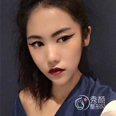 成都西区肖凌脂肪填充怎么样,有没有失败案例?