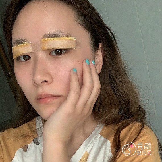 上海玫瑰聂利萍割双眼皮怎么样,有没有失败案例?