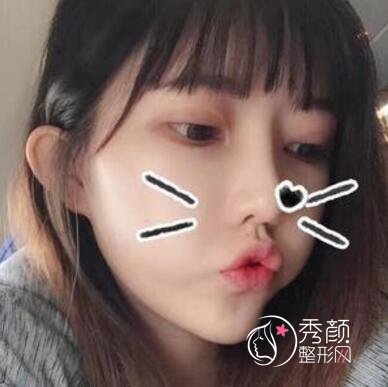 深圳金丽张亚军割双眼皮怎么样,有没有失败案例?