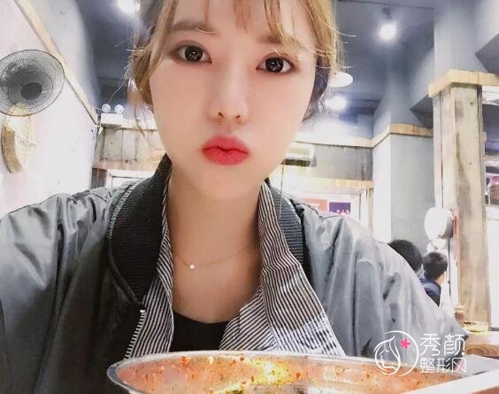 深圳金丽张亚军割双眼皮怎么样,有没有失败案例?