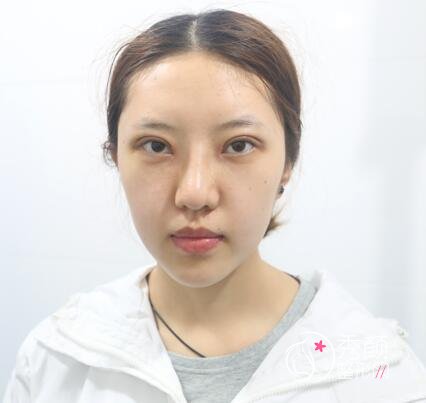 深圳金丽张亚军割双眼皮怎么样,有没有失败案例?