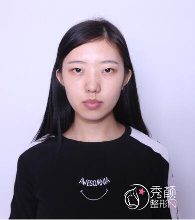 深圳金丽张亚军割双眼皮怎么样,有没有失败案例?