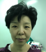 大惊喜！北京八大处埋线提升后年轻了不止10岁。