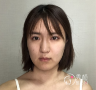 北京八大处做的射频微针看看我有什么变化吧！