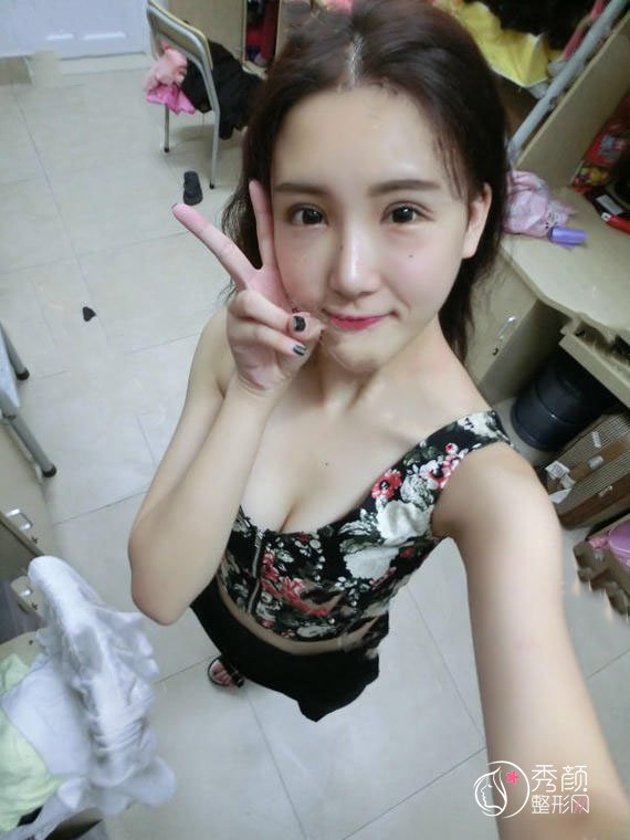 的杜园园医生做双眼皮怎么样,有没有失败案例?