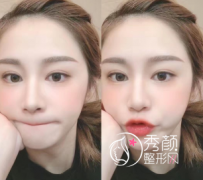 <b>做一次fotona4d面部提升大概需要多少钱</b>