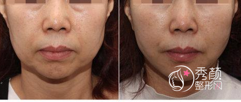 上海九院面部提升哪个专家好，张余光、金云波还是孙静?