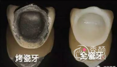 烤瓷牙有哪些种类,哪种果好,大概需要多少钱?