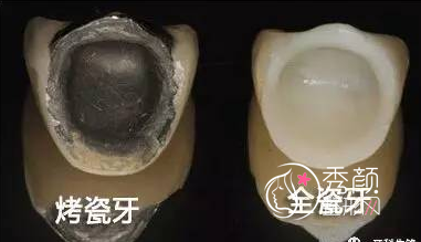 烤瓷牙有哪些种类,哪种果好,大概需要多少钱?