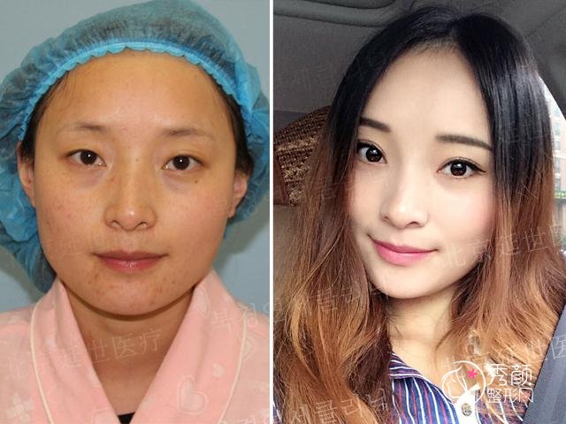 北京延世金奇龙割双眼皮怎么样，有没有失败案例