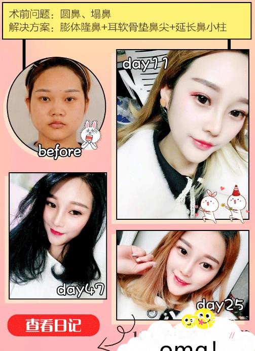 王瑾隆鼻怎么样，有没有失败案例