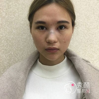 西安美莱杨帆医生隆鼻怎么样,有没有失败案例