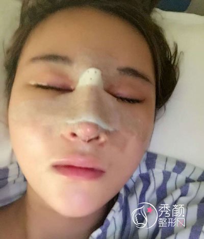 西安美莱杨帆医生隆鼻怎么样,有没有失败案例