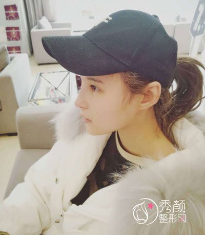 西安美莱杨帆医生隆鼻怎么样,有没有失败案例