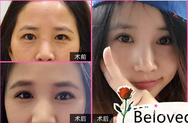 重庆爱思特朱家旭割双眼皮怎么样,有没有失败案例