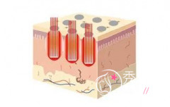 <b>fotona4Dpro、超声提拉哪个好</b>