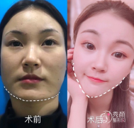 国内磨骨改脸型（颧骨内推/下颌角)较好的专家怎么选择?