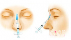 合肥艺星整形医院玻尿酸隆鼻怎么样,多久做一次？