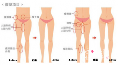 武汉中翰整形美容医院大腿吸脂怎么样