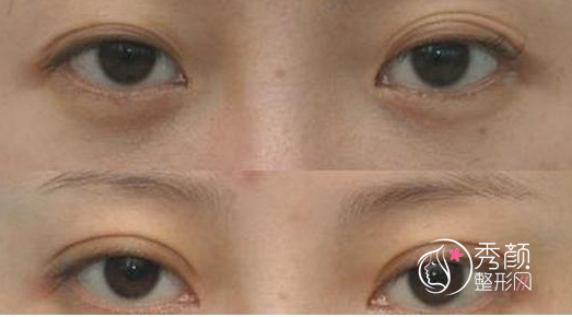 上海百达丽沈国雄双眼皮修复技术怎么样