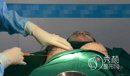 北京八大处整形赵延勇隆胸怎么样,大概需要多少钱?