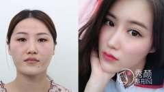 青岛亚美妍安翔医生双眼皮（修复）怎么样?