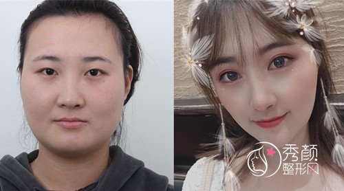 青岛亚美妍安翔医生双眼皮（修复）怎么样?